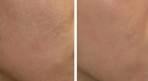 Peeling węglowy co daje? Efekty, korzyści i przeciwwskazania dla zdrowej skóry