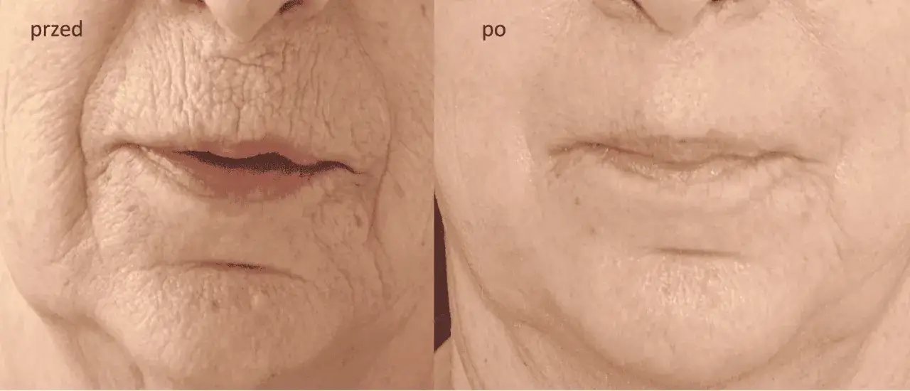 Zdjęcie Peeling fenolowy ile się goi - poznaj czas regeneracji skóry